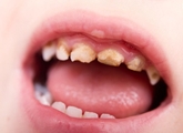 پوسیدگی دندان های شیری