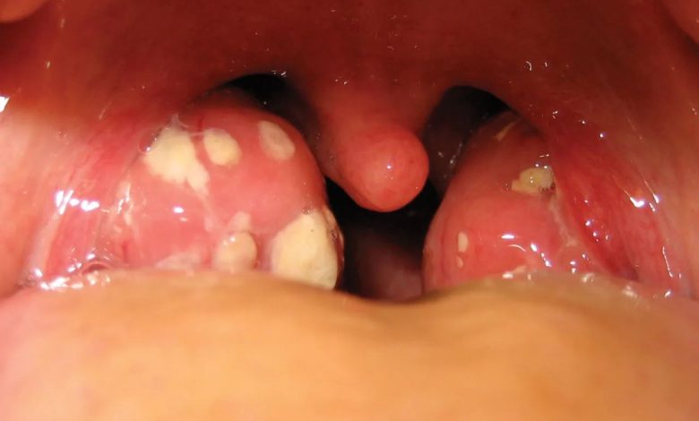 مونونوکلئوز عفونی